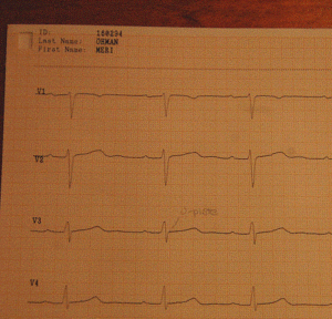 EKG